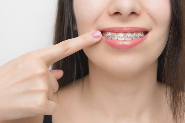 Dental braces in happy womans mouths who shows by finger on brackets on the teeth after whitening. Self-ligating brackets with metal ties and gray elastics or rubber bands for perfect smile. Orthodontic teeth treatment.